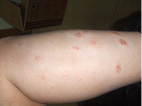 银屑病早期有哪些症状表现