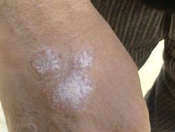 代谢障碍为什么会引发银屑病?