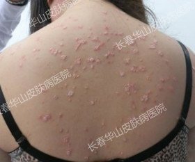 初期银屑病有什么表现