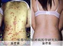 银屑病治疗