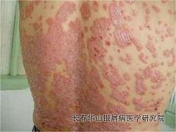 银屑病症状