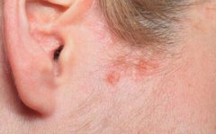 牛皮癣的常见误区有哪些 牛皮癣的常见误区有哪些