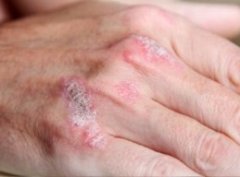 手上出现牛皮癣的原因 手上出现牛皮癣的原因