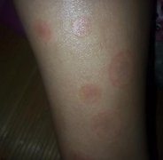 牛皮癣可以补充哪些维生素 牛皮癣可以补充哪些维生素