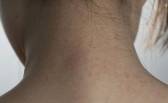 孩子身上为什么会长牛皮癣 孩子身上为什么会长牛皮癣