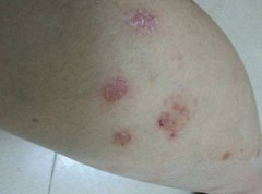 牛皮癣日常生活如何做 牛皮癣日常生活如何做