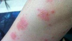 初期牛皮癣怎么治疗 初期牛皮癣怎么治疗