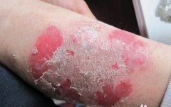 牛皮癣致病原因 牛皮癣致病原因