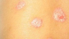 牛皮癣如何洗澡 牛皮癣如何洗澡