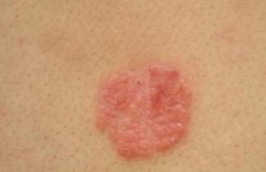 日常中吃什么蔬菜对牛皮癣皮肤病有帮助呢 日常中吃什么蔬菜对牛皮癣皮肤病有帮助呢