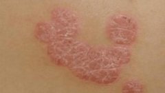 一般人的牛皮癣饮食谨慎都有什么呢 一般人的牛皮癣饮食谨慎都有什么呢