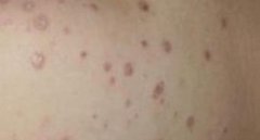 如果家里有孕妇患者要如何预防牛皮癣复发 如果家里有孕妇患者要如何预防牛皮癣复发