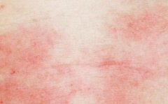 牛皮癣患者的日常用药禁忌有什么问题 牛皮癣患者的日常用药禁忌有什么问题