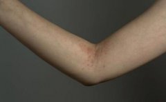 牛皮癣患者治疗常用药有哪些 牛皮癣患者治疗常用药有哪些