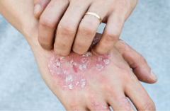 牛皮癣患者在治疗期间要如何护理 牛皮癣患者在治疗期间要如何护理