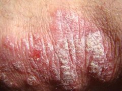 面部患上牛皮癣的患者出去可以化妆吗 面部患上牛皮癣的患者出去可以化妆吗